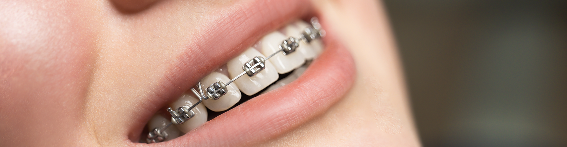 smiling mouth with braces